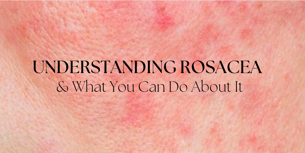 Understanding Rosacea and What You Can Do About It – Pure and Simple