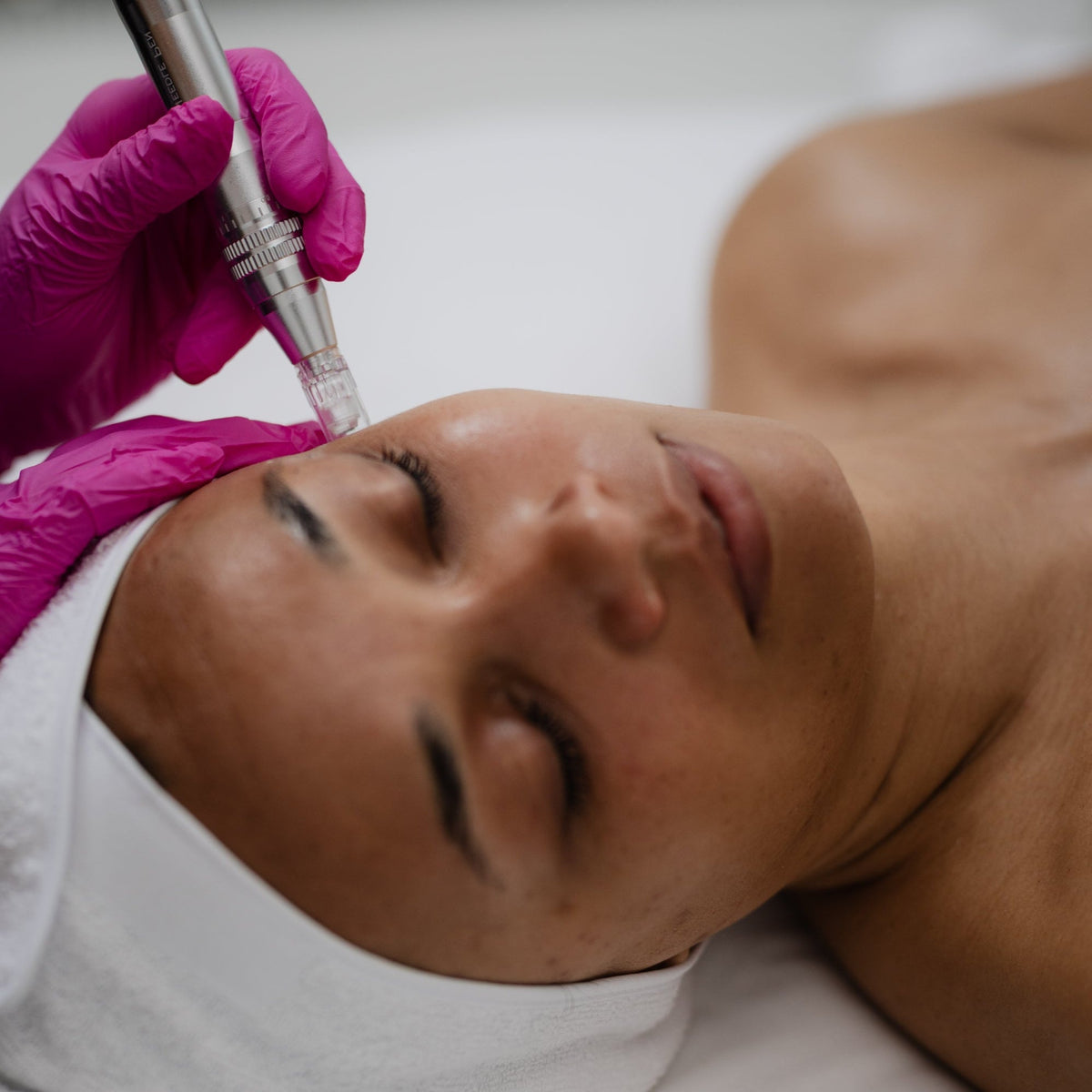 Microneedling