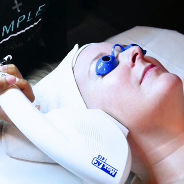 IPL Acne Treatment