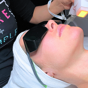 IPL Rosacea Treatment
