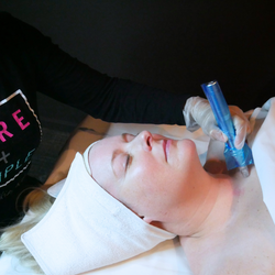 Microneedling Décolleté Add-On