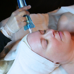 Microneedling