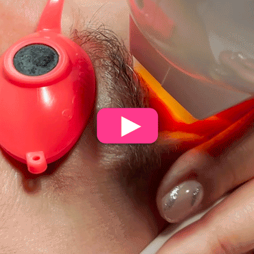 IPL PhotoFacial